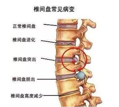 椎間盤常見病變