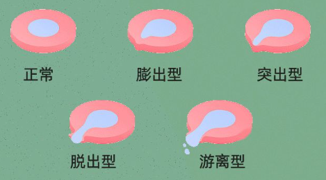 椎間盤突出四階段