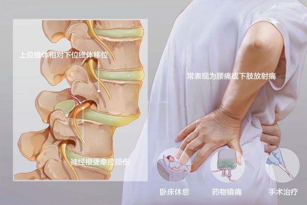 腰椎滑脫