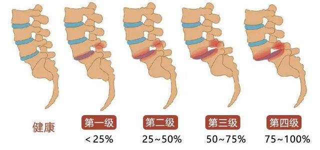 腰椎滑脫分級