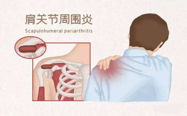 肩周炎