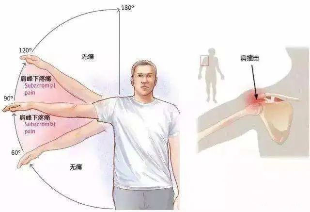 肩關節活動受限