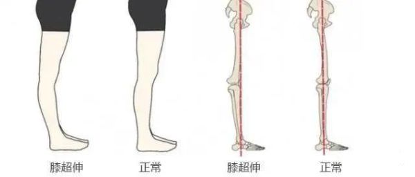 膝超伸對比圖