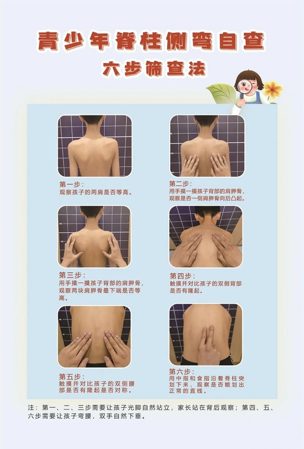 脊柱側彎六步篩查法