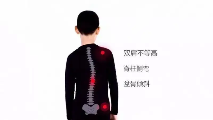 脊柱側彎
