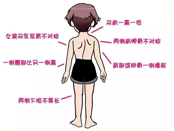 脊柱側(cè)彎癥狀