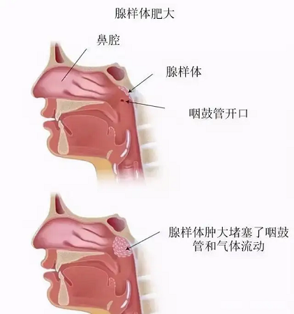 腺樣體肥大