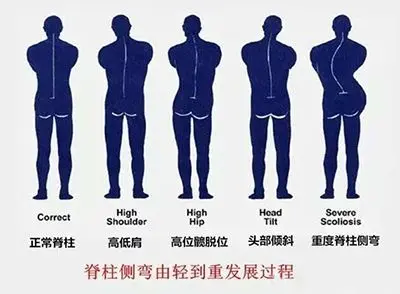 脊柱側彎由輕到重發展過程