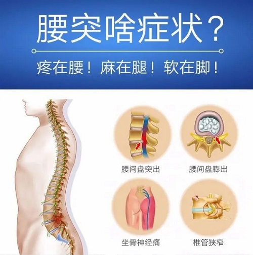 腰椎間盤突出