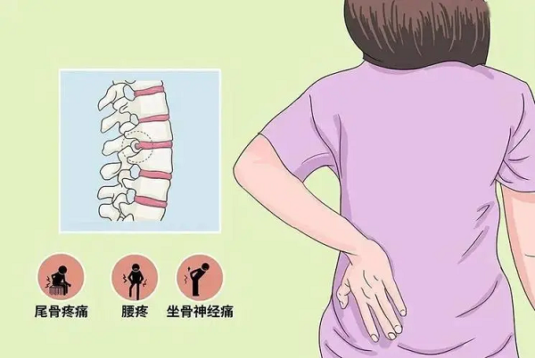 腰椎間盤(pán)突出癥癥狀