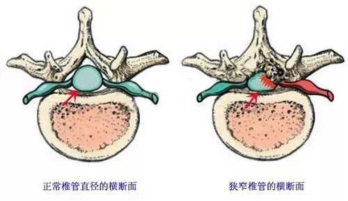 正常椎管和椎管狹窄橫斷面對比圖