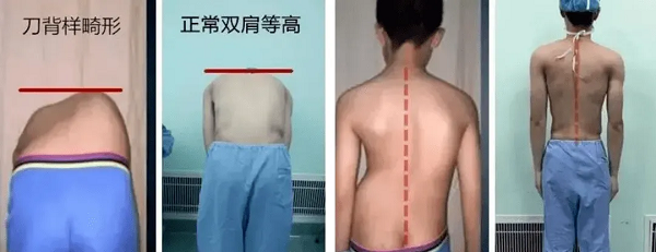 居家彎腰實驗觀察背部異常