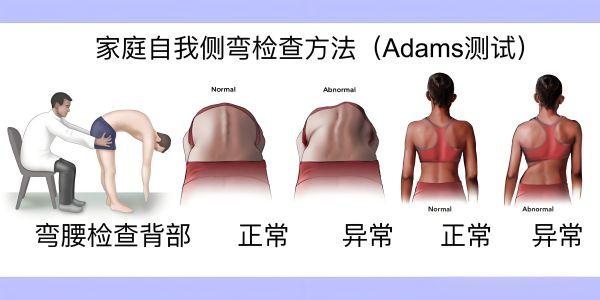 脊柱側彎自測方法