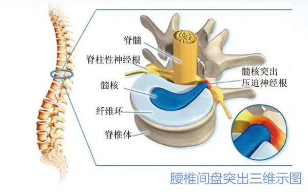 腰椎間盤突出三維示圖