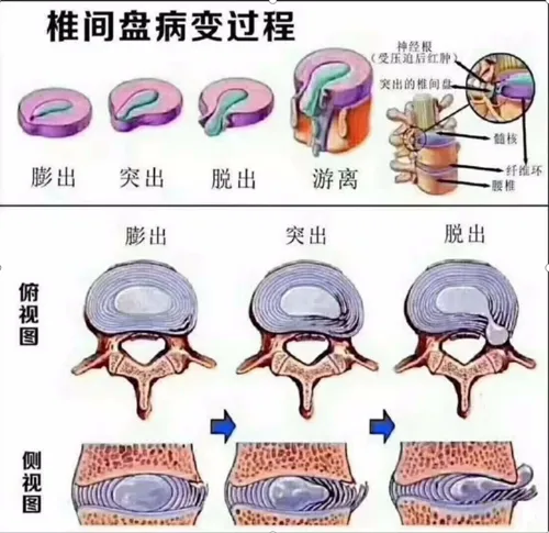 椎間盤病變過程