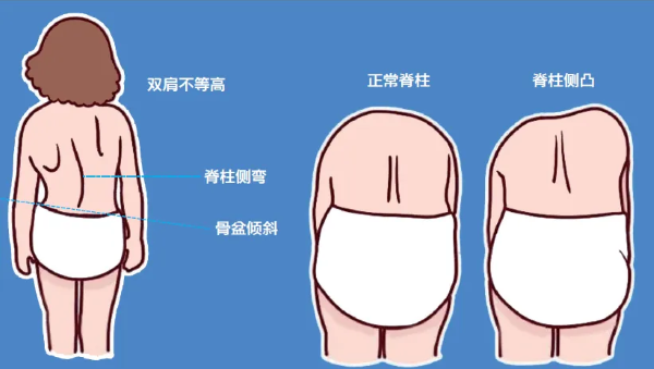 脊柱側彎體征