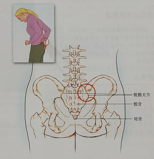 骶髂疼痛