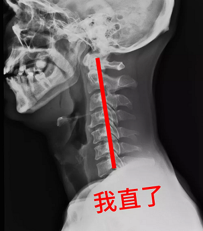 頸椎生理曲度變直